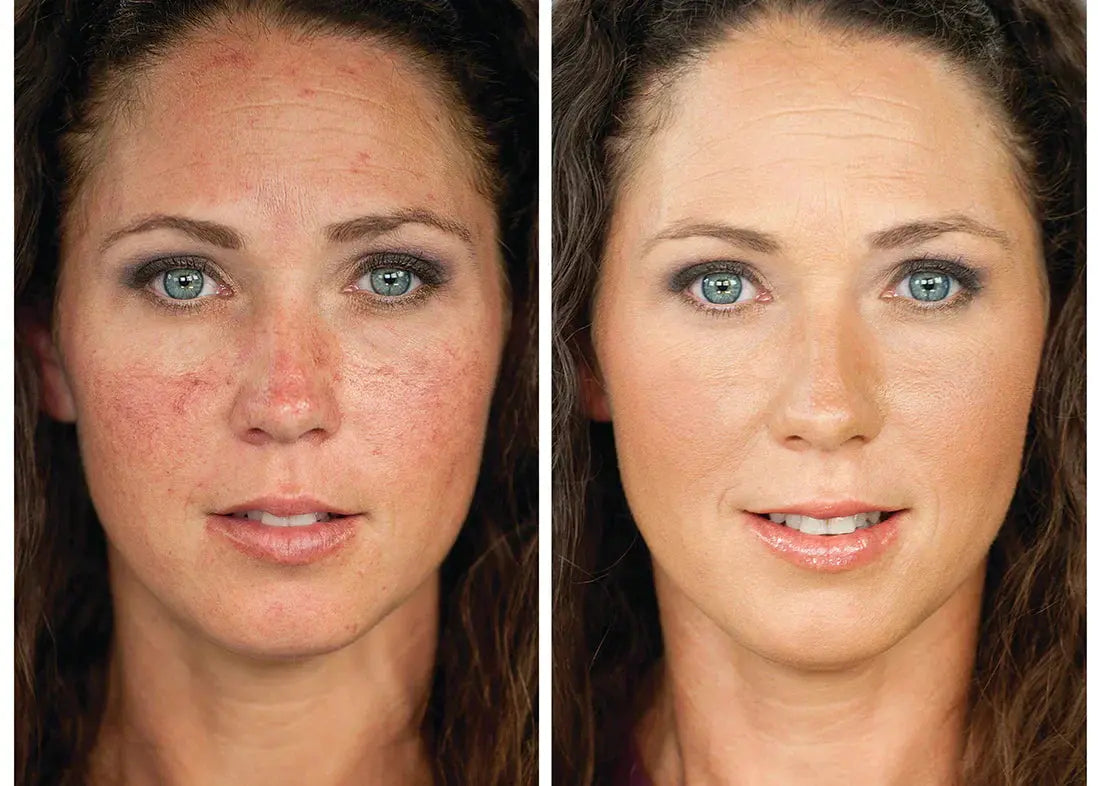 Meest-voorkomende-triggers-van-rosacea Colorescience NL